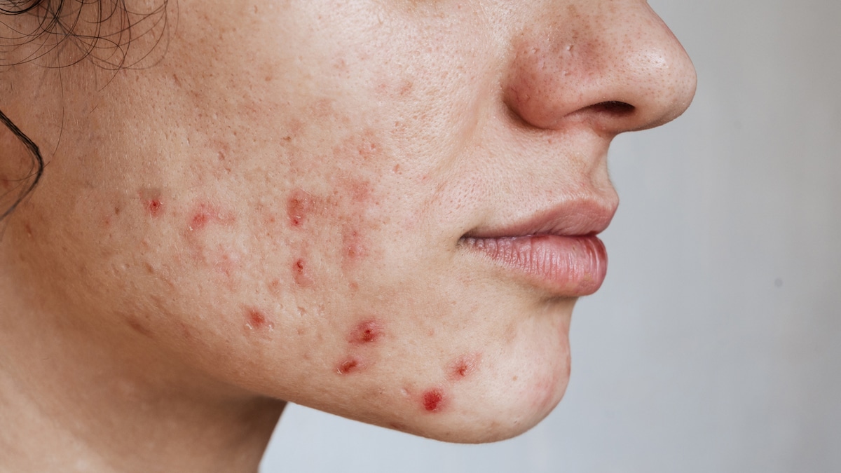 What To Eat To Beat Hormonal Acne? Experts Share Tips And Foods To Eat
