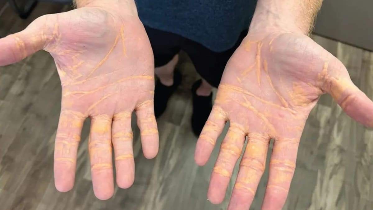 Man Ate Only Cheese, Butter, Hamburgers On Carnivore Diet – Develops Oozy Yellow Nodules On Body