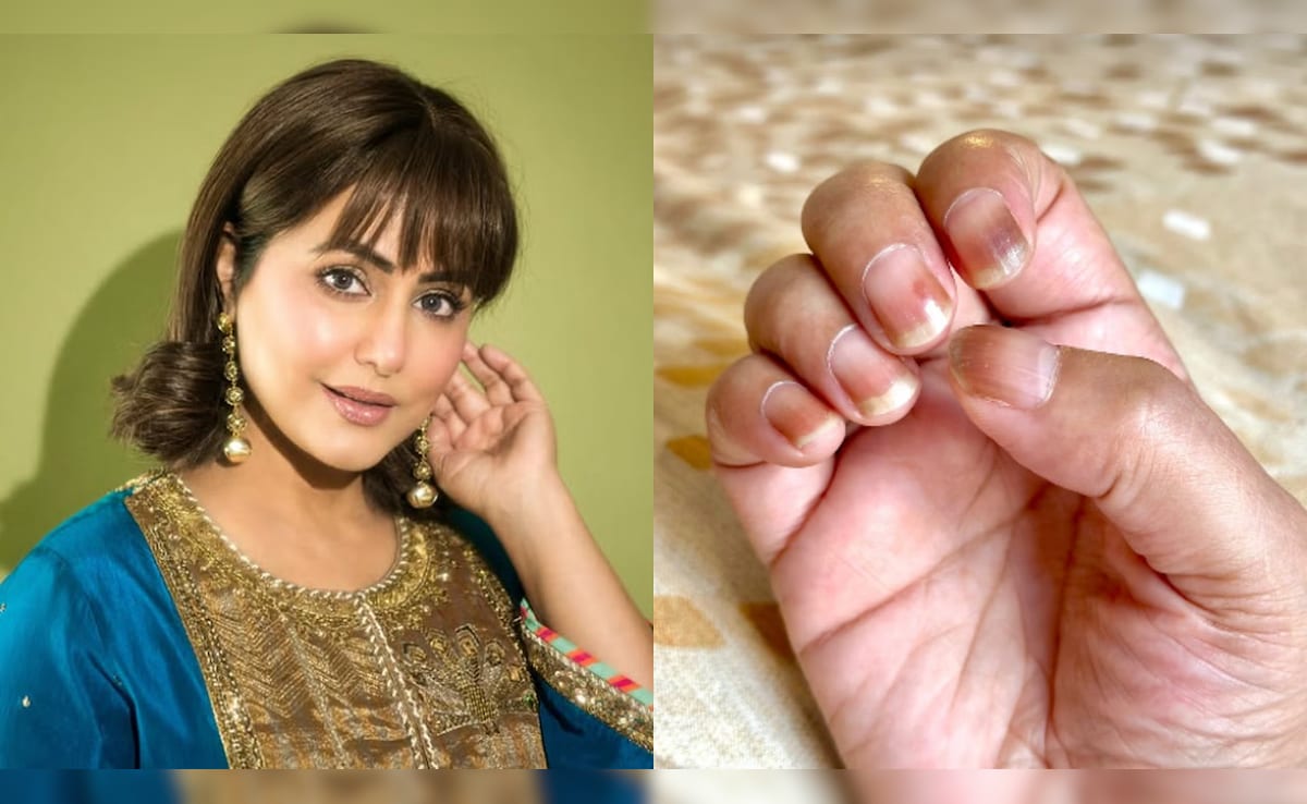 "My Nails Have Become Brittle And Dry"