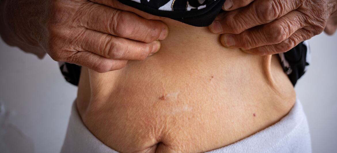Maryna shows a scar on her stomach, a result of the attack at her home in Kherson Oblast, Ukraine.